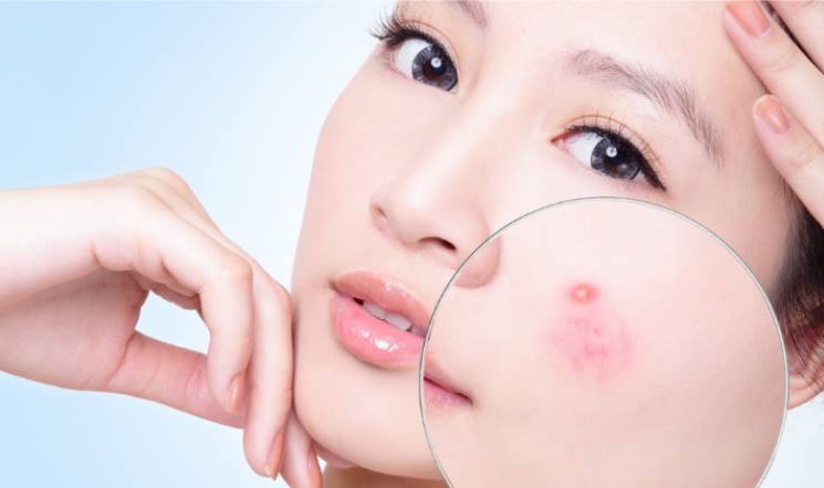 Các nguyên nhân gây ra mụn và cách điều trị