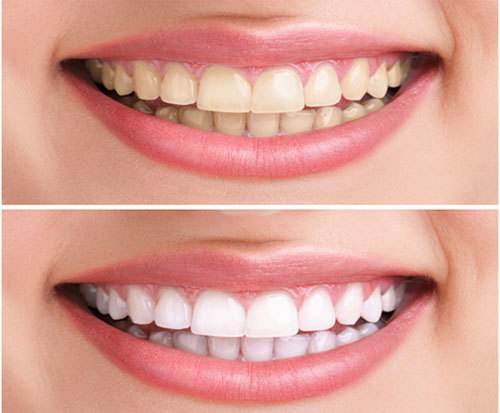 Các loại kem đánh răng tốt nhất hiện nay